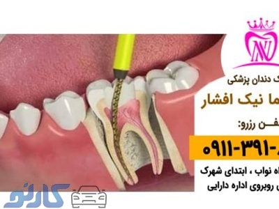 عصب کشی و نمونه برداری دندان در بابل ،  بابلسر | دکتر نیما افشار