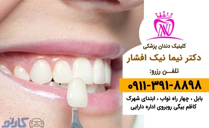 بهترین دندان پزشک زیبایی و کامپوزیت ونیر در بابل ، بابلسر | دکتر نیما افشار
